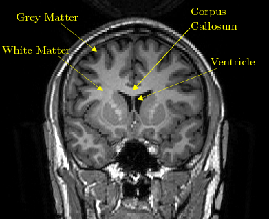 Brain image