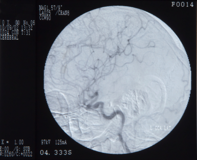 Cerebral angiography