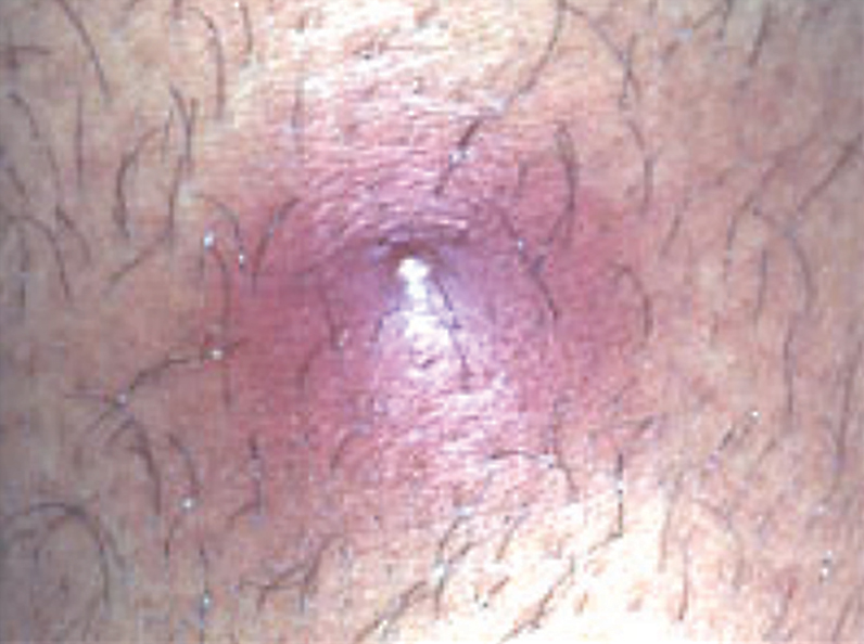 MRSA mistaken for ingrown hair or pimple