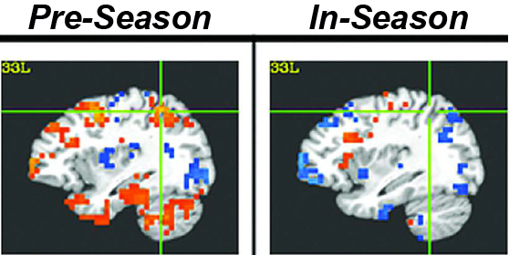 fMRIs of cognitively impaired football players